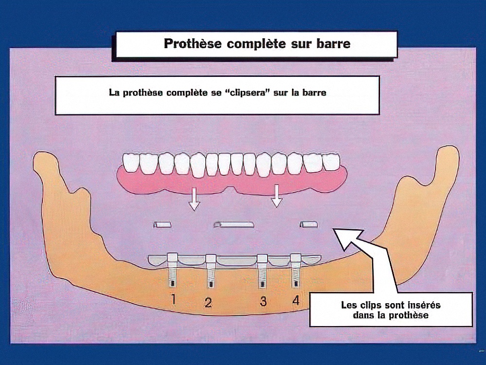 Prothèse complète barre sur implants Strasbourg